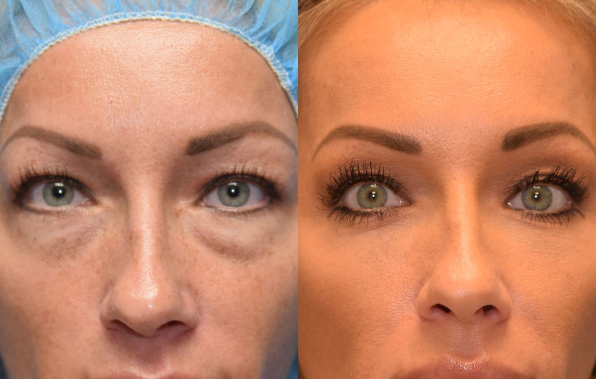 Can Cosmetic Surgery Remove Eye Bags Iucn Water 